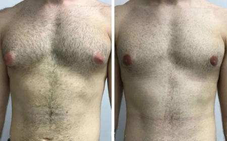 Expert Tips from the Best Doctors in Dubai on Managing Gynecomastia