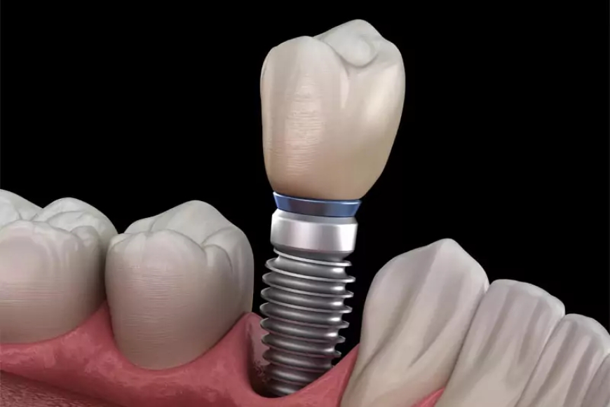 What Materials Are Used in Dental Implants and Why It Matters